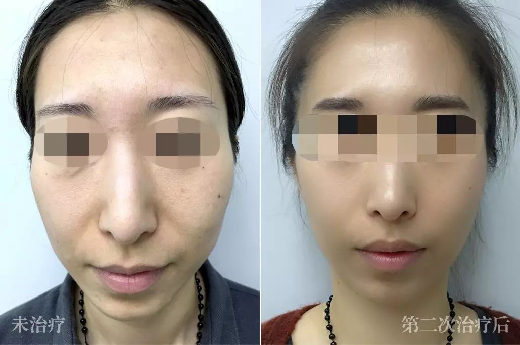 热拉提真人治疗对比图