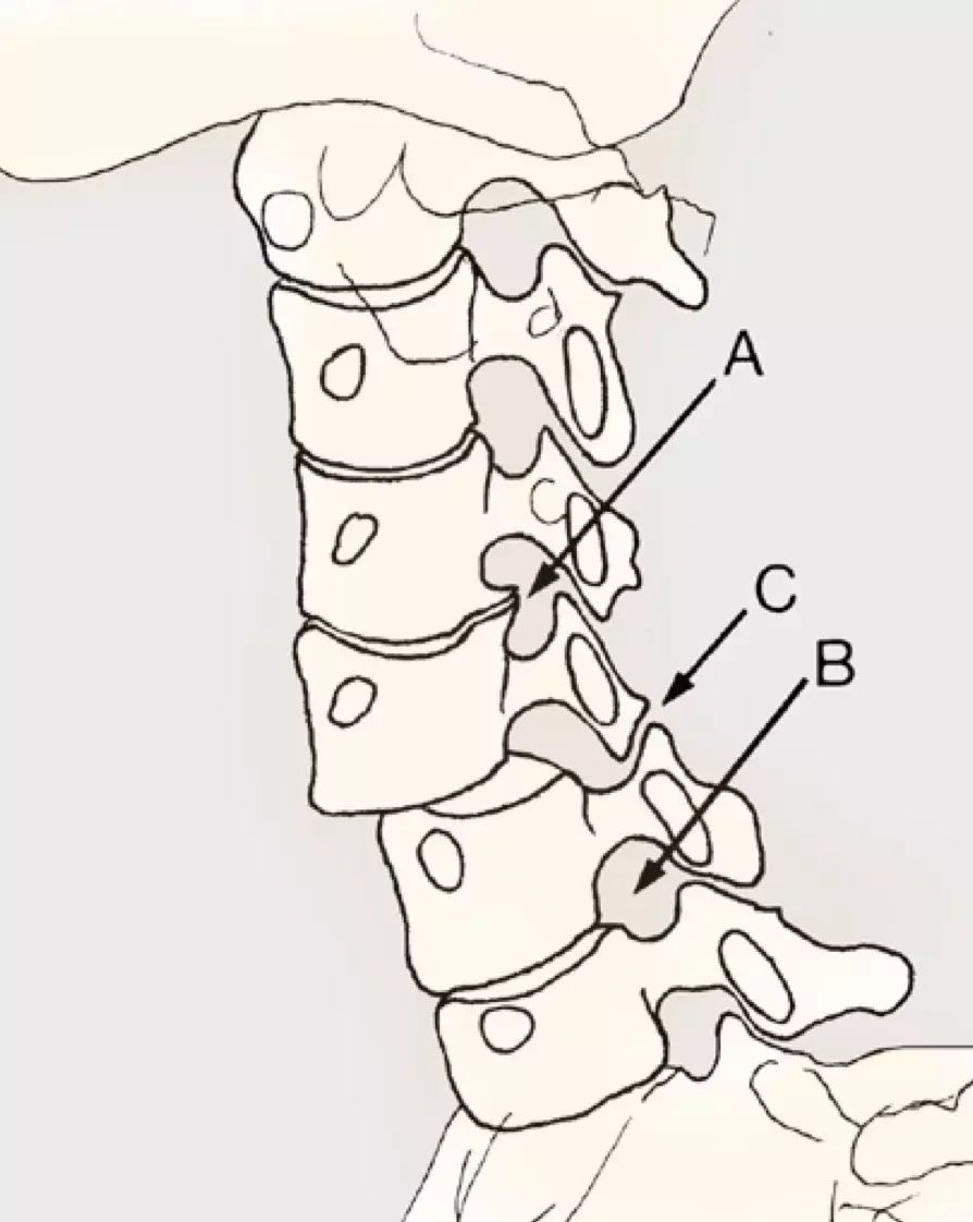 如何读懂颈椎x线片