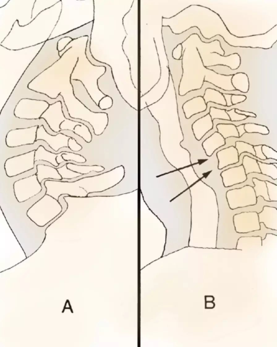 对于侧位上怀疑有颈椎不稳的患者应加拍颈椎过伸,过屈位片,通过比较常