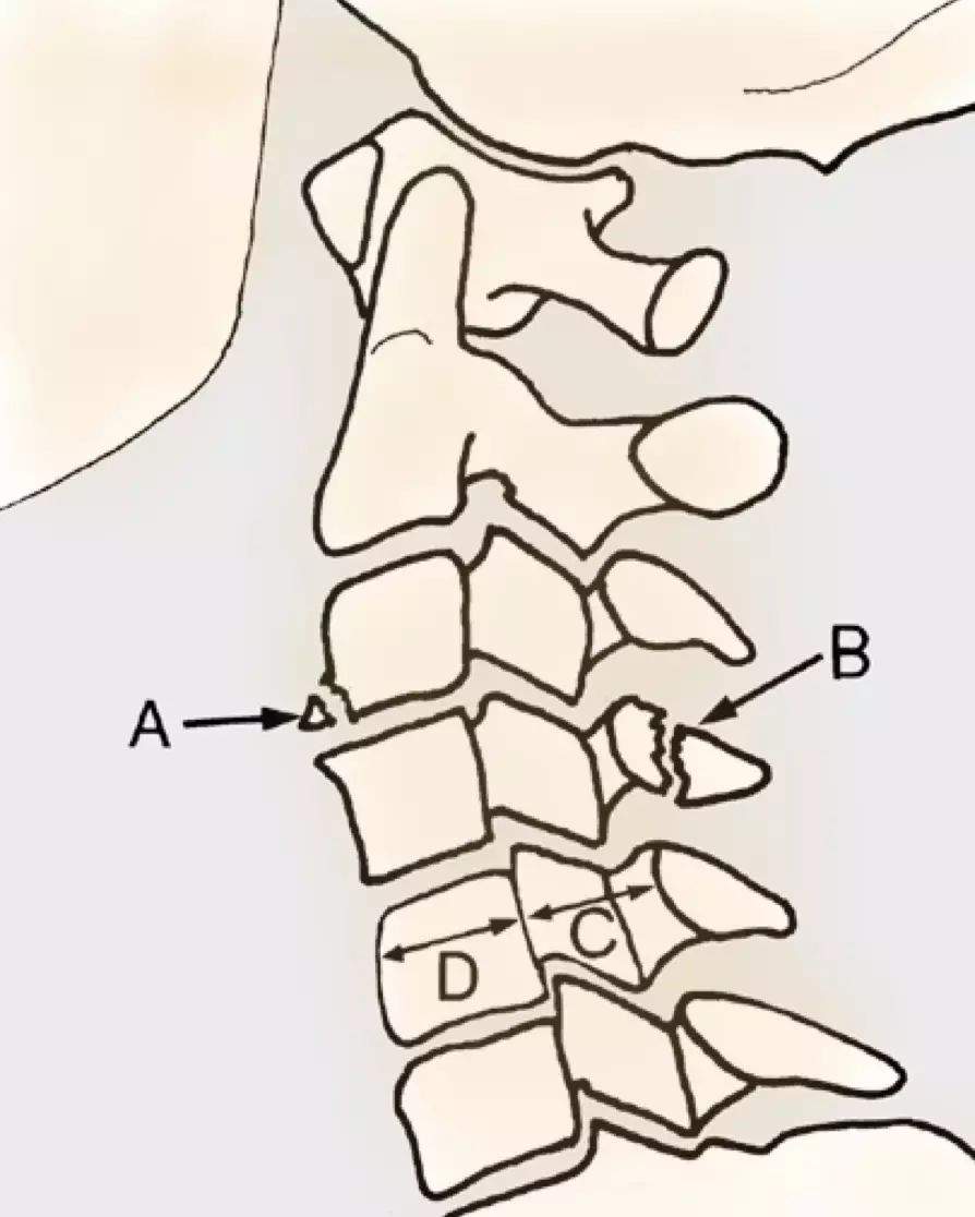 a 骨赘或椎体前缘的骨折,见于颈部过伸性损伤.