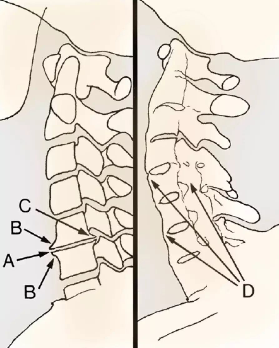 a 椎间隙变窄 b 前缘唇样变 c 后缘唇样变 d 强直性脊柱炎所致的椎体