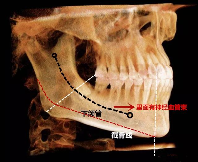 下颌骨遍布神经血管,截骨一定要避开下颌管的位置.