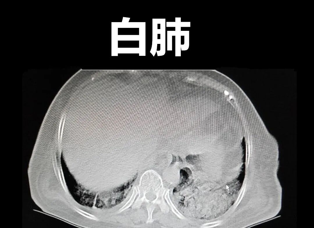 阳了后担心自己得白肺？五个中药方帮你消除后顾之忧。