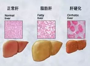 一位重度脂肪肝患者的自述：珍爱生命 坚持运动