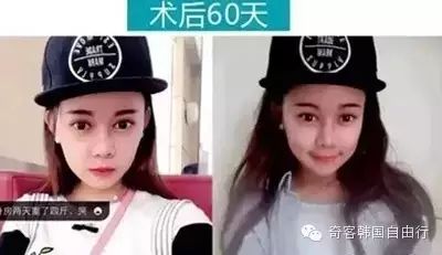 她花了100万韩国整形，从丑小鸭整到Angelababy！