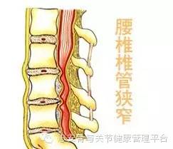 脊椎 管 狭窄 症