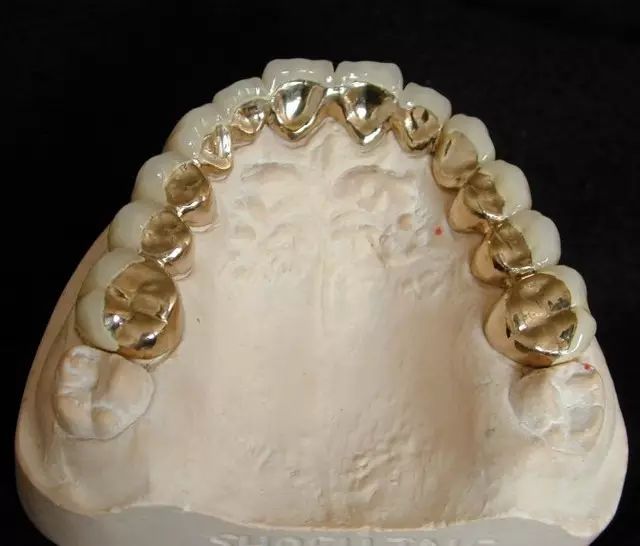 做烤瓷牙为什么要留金属边？