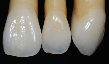 做烤瓷牙为什么要留金属边？