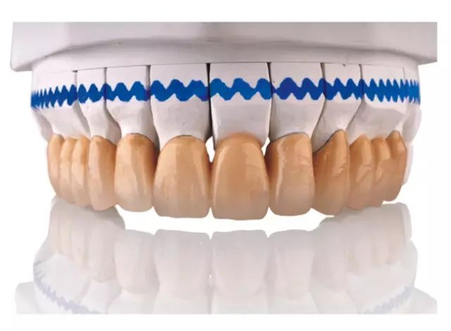 做烤瓷牙为什么要留金属边？