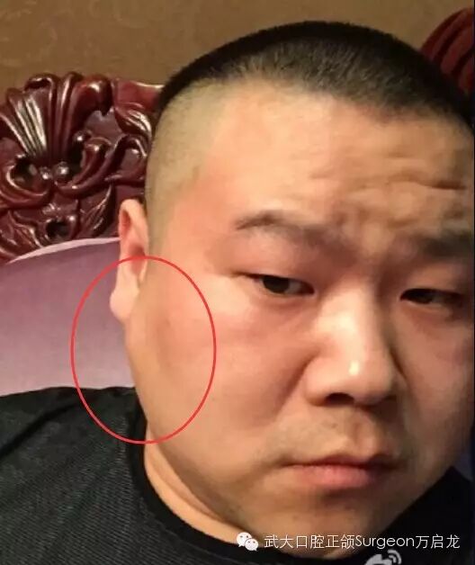 浅谈德云社相声演员岳云鹏的腮腺“小瘤”