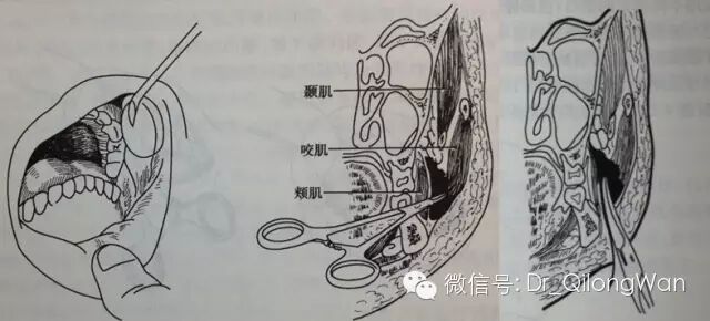 小小牙疼，何以致命？！