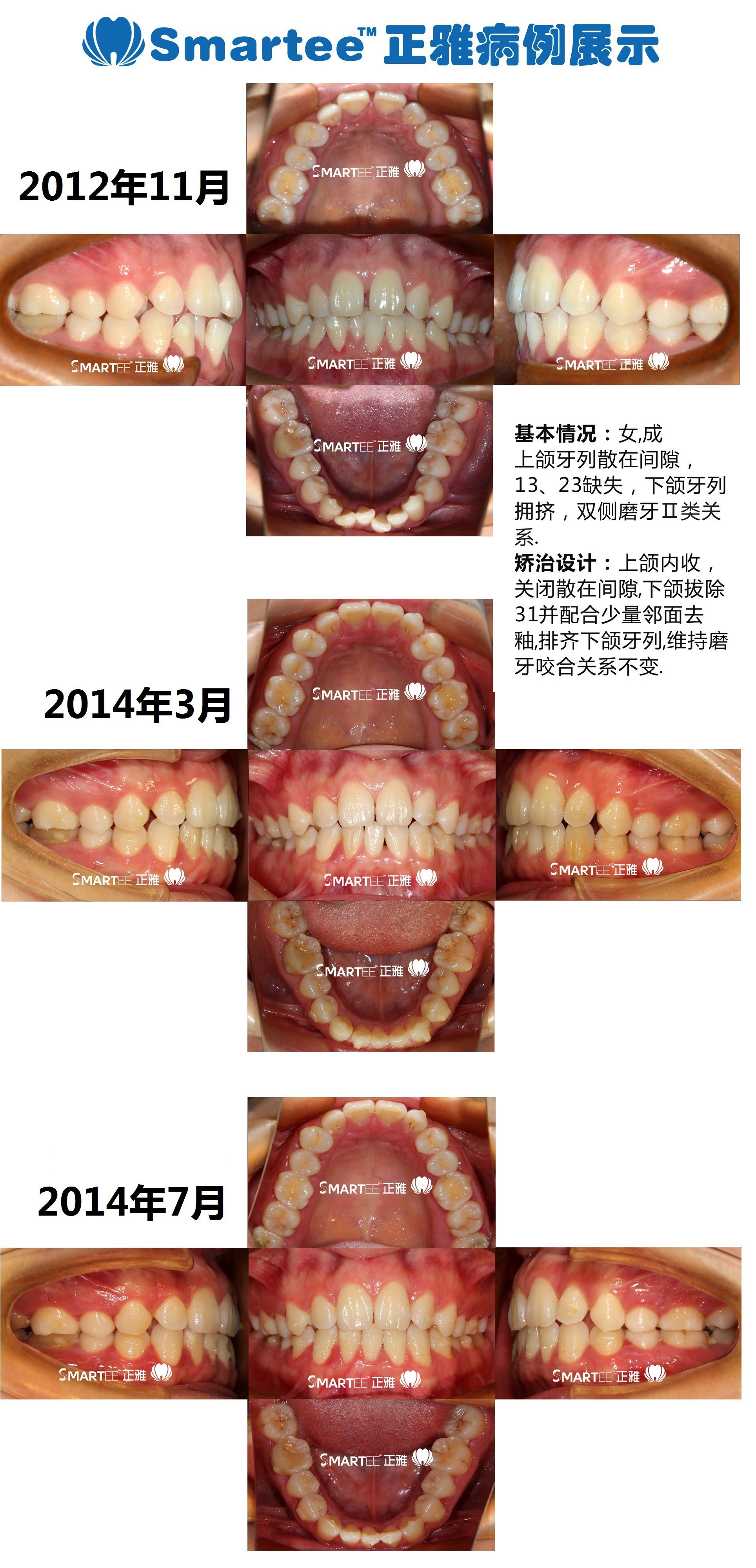 Smartee正雅(牙合)垫附件,有效解除反(牙合)-Smartee正雅的博客-KQ88口腔博客