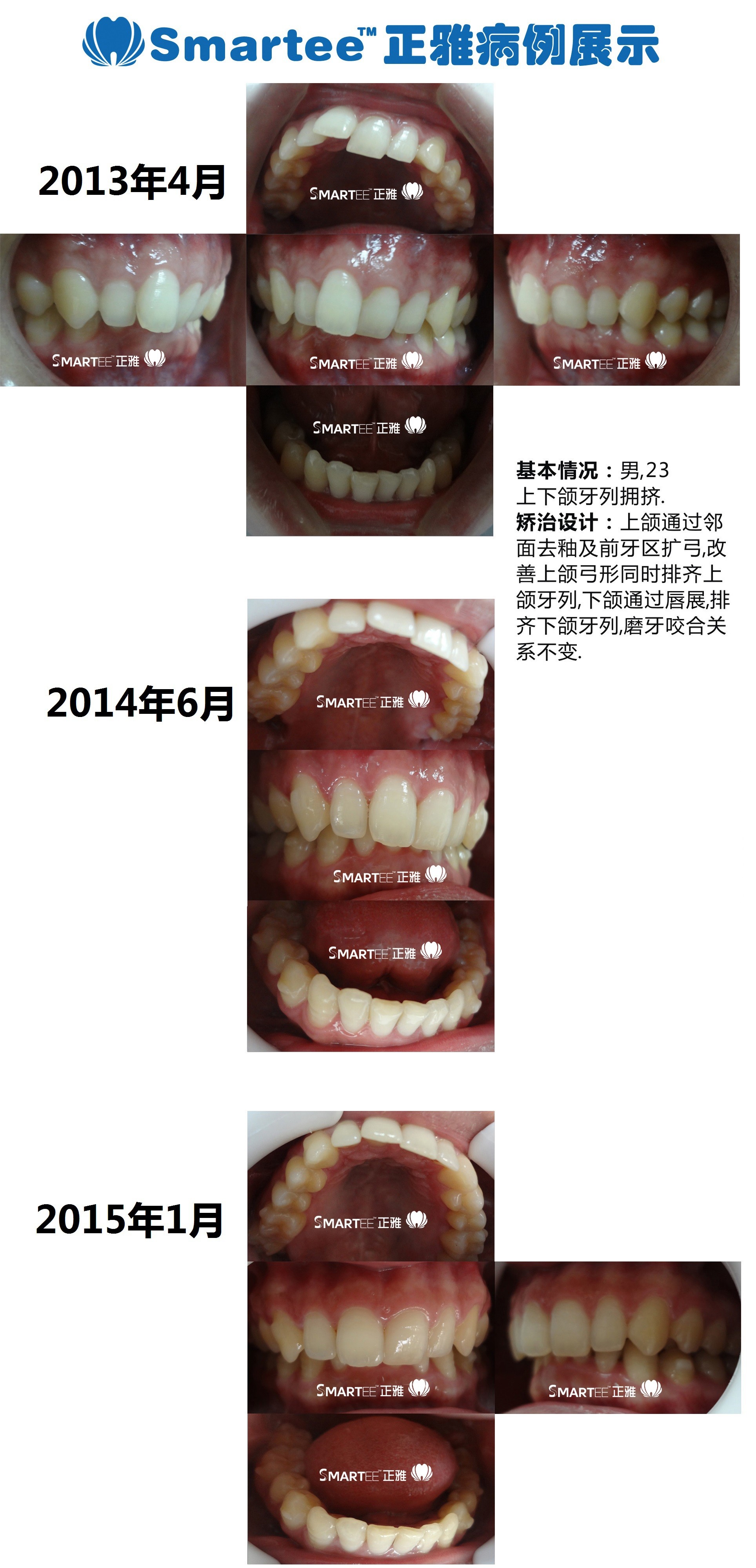 开颌女生正畸正颌，颜值健康两不误！ - 贝致案例库 - 贝致——专业口腔服务平台，权威医生，真实案例，一次看够