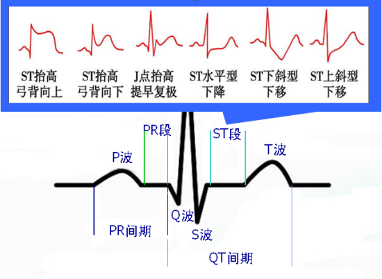 这些特征心电图改变，都是猝死的前兆