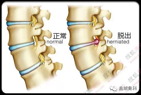 椎间孔镜治疗的适应症 转载