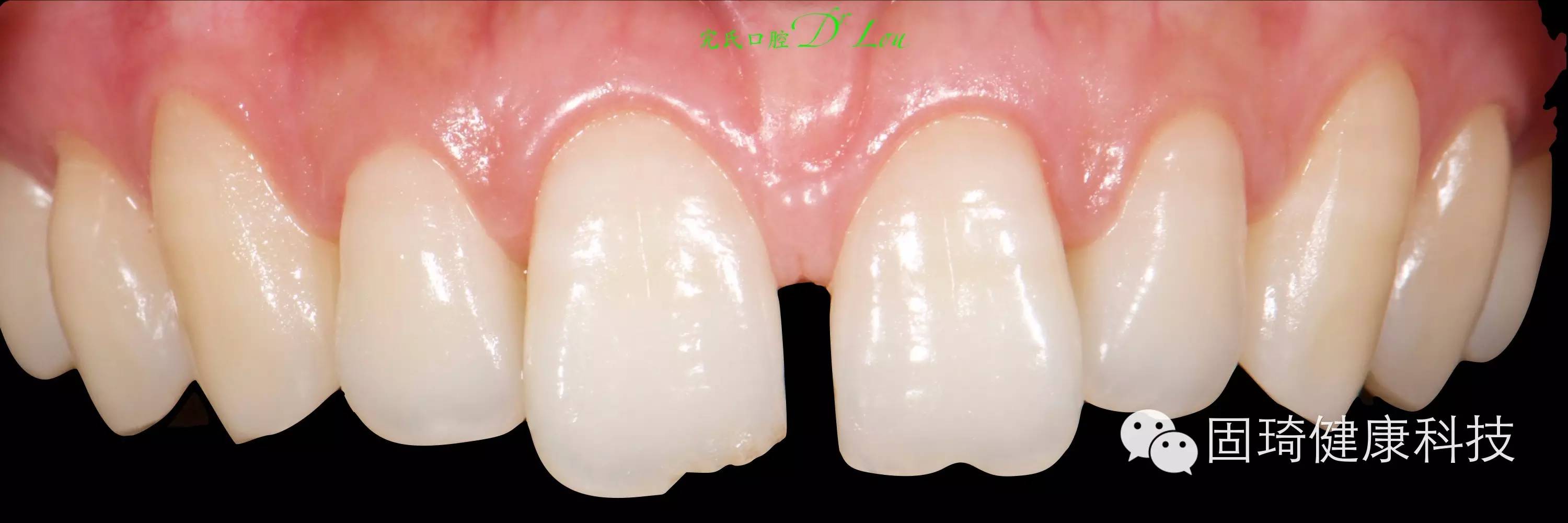 一例树脂关闭前牙间隙-王生洲的博客-KQ88口腔博客