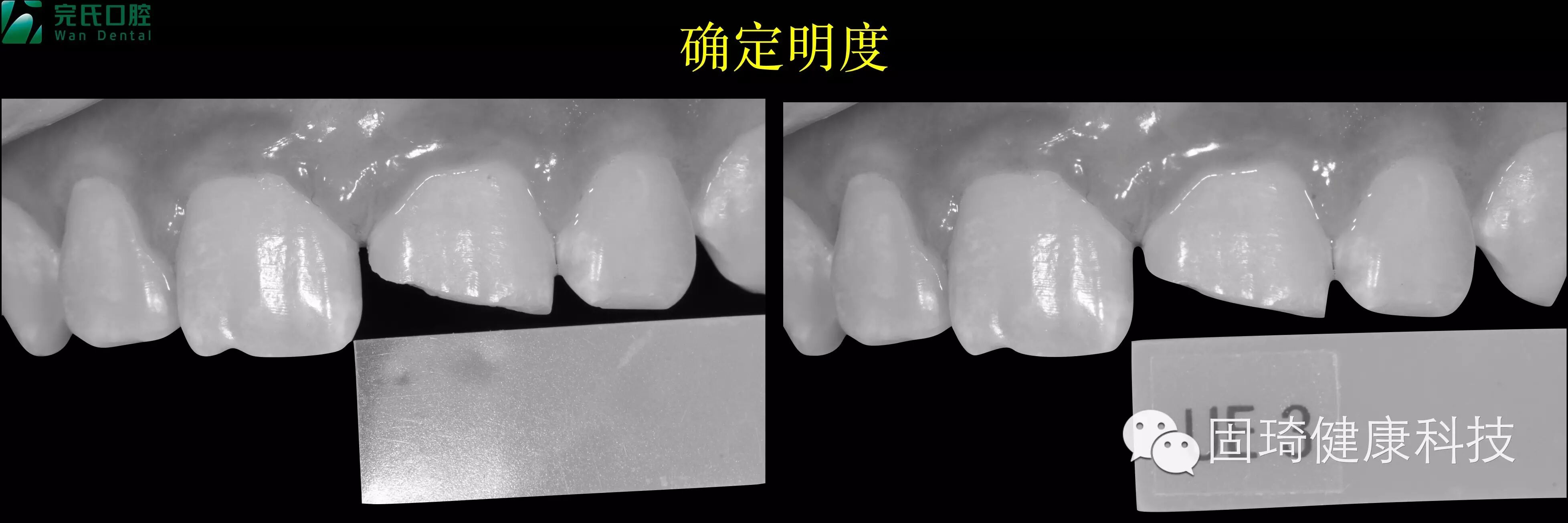 前牙美塑树脂美学充填——完氏韦欣医生-固琦健康的博客-KQ88口腔博客
