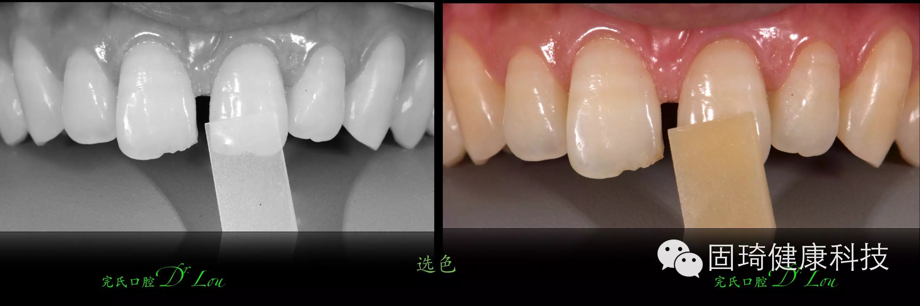 Hibeauty隐秀「牙列间隙／多牙位缺失/正畸种植修复联合矫治」案例分享 - 知乎