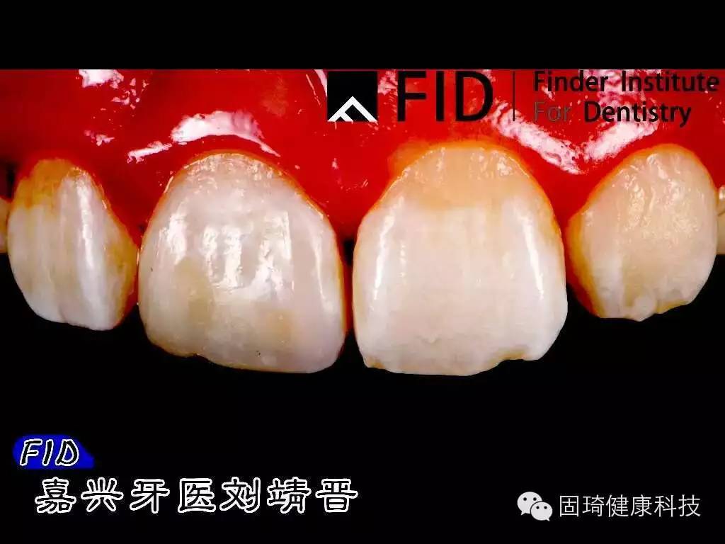 2例树脂前牙充填 VS “CERAMAGE”聚合瓷高嵌体-王玉楼的博客-KQ88口腔博客