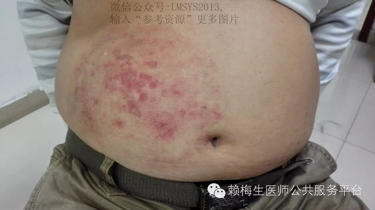 手足 股部瘙痒难忍 很可能是癣 怎么办