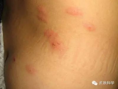 《“虫咬皮炎”怎么办？》