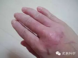 《”主妇手“能好吗？怎么处理？》