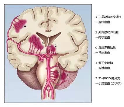 临床医学 快速学会脑出血部位辨识 即时医疗