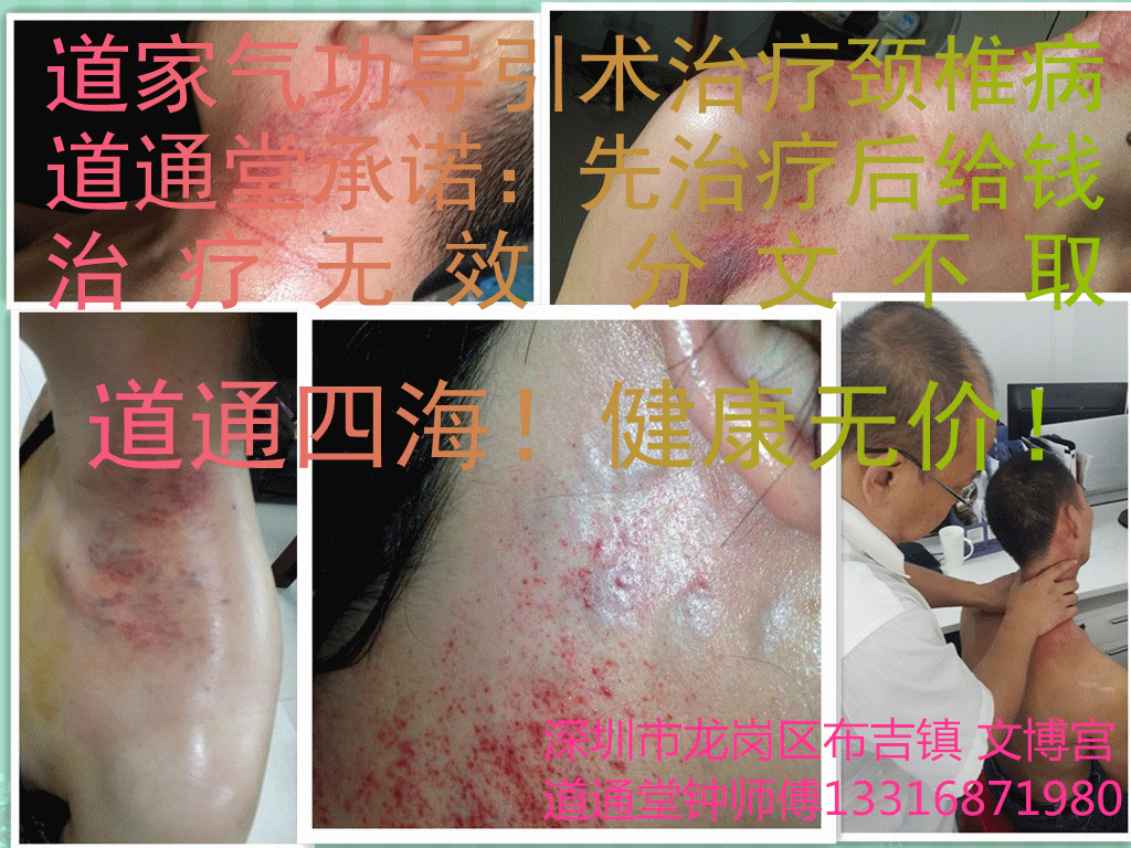 颈椎病病理及治疗方法 <wbr><wbr><wbr>！ <wbr><wbr><wbr>！ <wbr><wbr><wbr>！