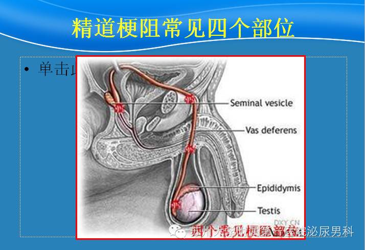 经尿道精阜后唇切除术治疗射精管梗阻的前瞻性探讨 尿路梗阻 手术