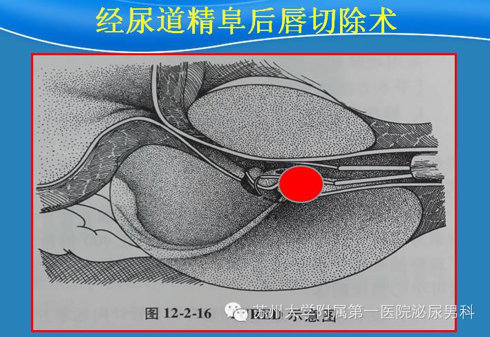 经尿道精阜后唇切除术治疗射精管梗阻的前瞻性探讨 尿路梗阻 手术