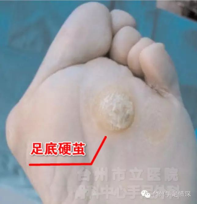 使得第二,三腳趾承受過多的人體重量,久而久之在前腳掌相應處就會