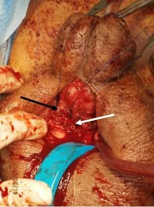 (普外时间-原创编译)教训:腹股沟疝修补术致尿道与阴茎海绵体完全性离