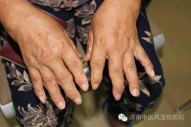 我为中医代言系列之— "中医,让她走出二十年类风湿阴影