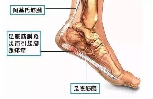 跑步后脚底痛 脚跟痛 越压越痛 究竟因为什么 健康知识 泓华国际诊所 安全有效温馨便捷