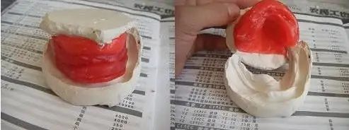 做全冠为什么要备牙肩台