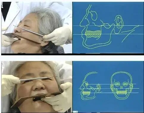 做全冠为什么要备牙肩台