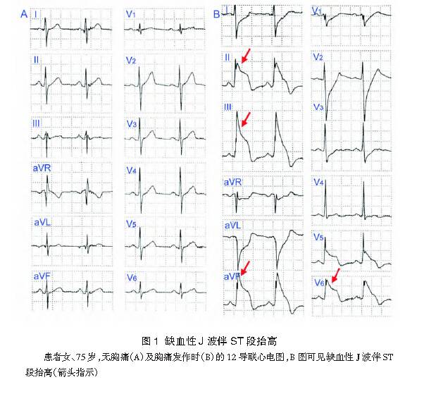 这些特征心电图改变，都是猝死的前兆