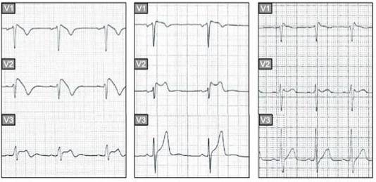 这些特征心电图改变，都是猝死的前兆