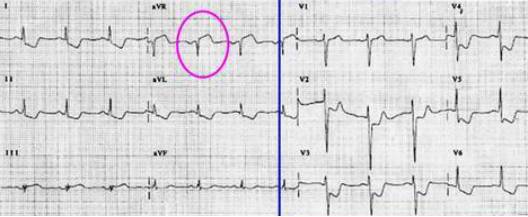 这些特征心电图改变，都是猝死的前兆