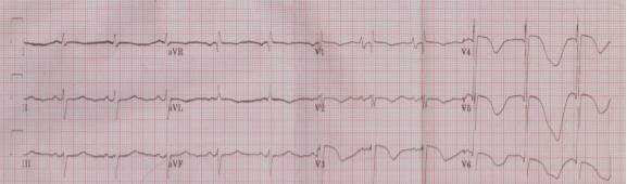 这些特征心电图改变，都是猝死的前兆