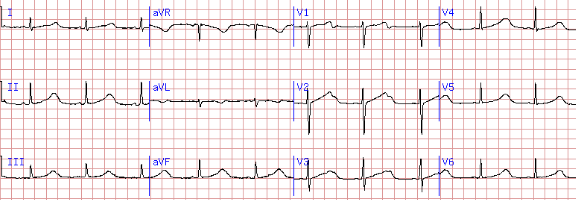 这些特征心电图改变，都是猝死的前兆