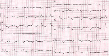 这些特征心电图改变，都是猝死的前兆