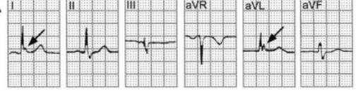 这些特征心电图改变，都是猝死的前兆