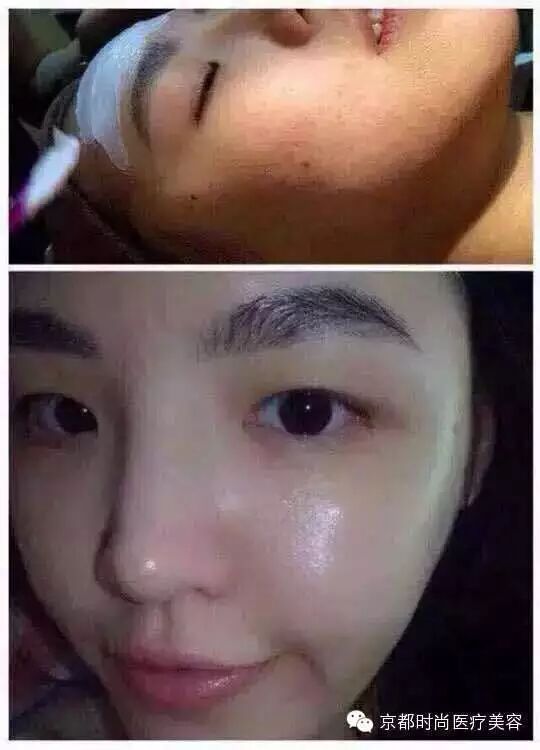 水光针 童颜容貌做 无龄 女神 京都时尚 常青 新浪博客