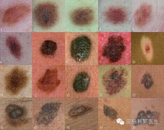 小小痦子竟成皮肤癌