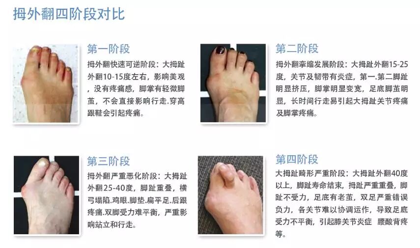 拇外翻康复指南