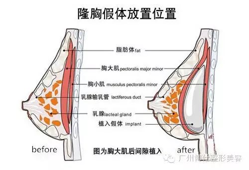 隆胸后会不会引发乳腺癌 广州博仕整形 新浪博客