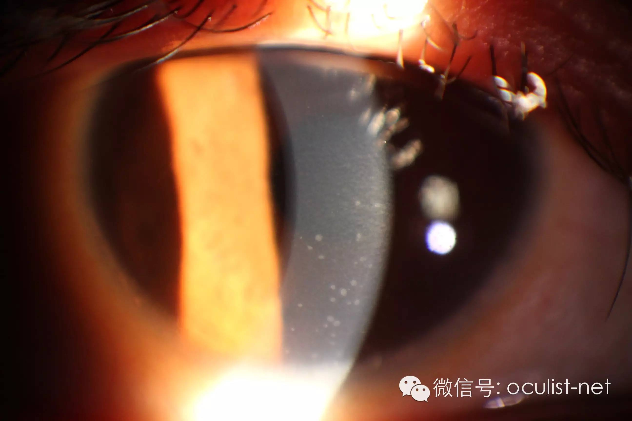 裂隙灯的检查流程和常见眼部问题总结 - 知乎