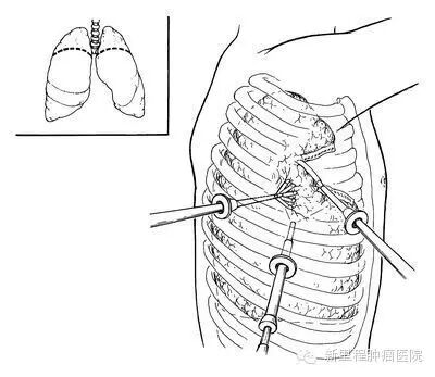 重度肺气肿患者福音——胸腔镜肺减容微创手术