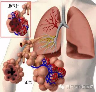 重度肺气肿患者福音——胸腔镜肺减容微创手术